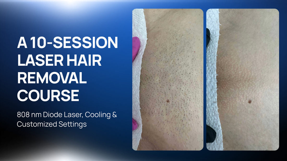 Laser Hair Removal in the Brazilian Area: A 10-Session Course for Coarse Hair