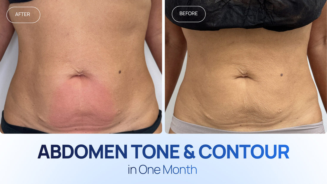 How to Build an Abdomen Tone & Contour Protocol: Zemits EndoLuxx Pro + Zemits Abigon Pro Case Study