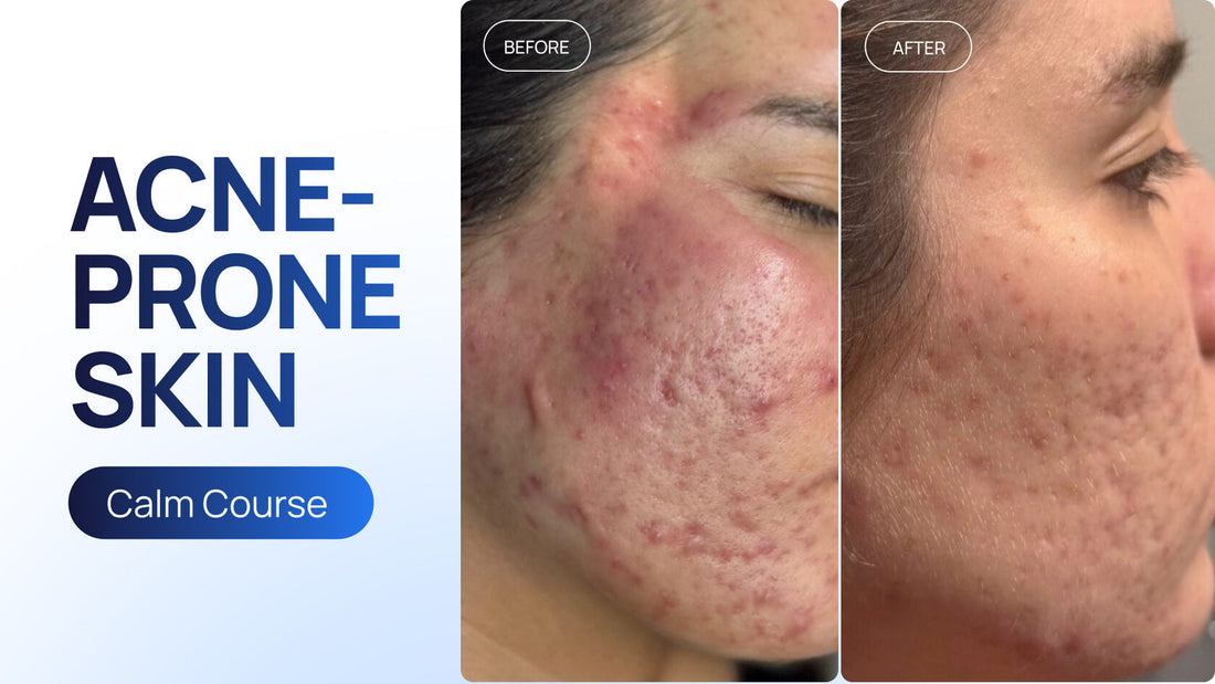 Cold Plasma + Cold Therapy: A Course-Based Approach to Acne-Prone Skin