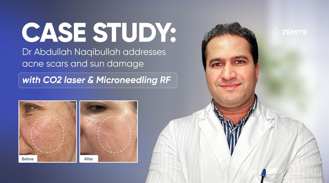Case study: Dr Abdullah Naqibullah addresses acne scars and sun damage with CO2 laser & Microneedling RF.