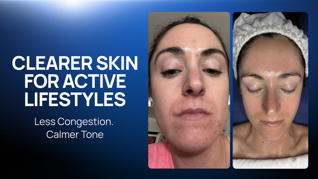 How to Build a Monthly Protocol for Breakout-Prone Skin: A Case Study