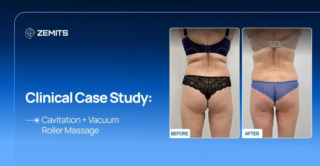 Clinical Case Study: Cavitation + Vacuum Roller Massage