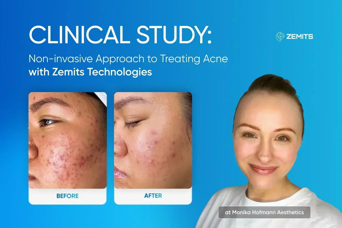 Clinical Study: Non-invasive Approach to Treating Acne with Zemits Technologies at Monika Hofmann Aesthetics
