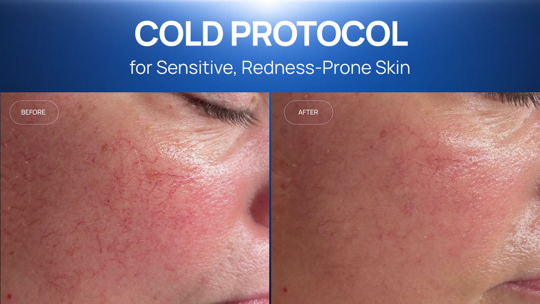 How a Cold Plasma and Cooling Protocol Calmed Sensitive, Redness-Prone Skin in Two Sessions
