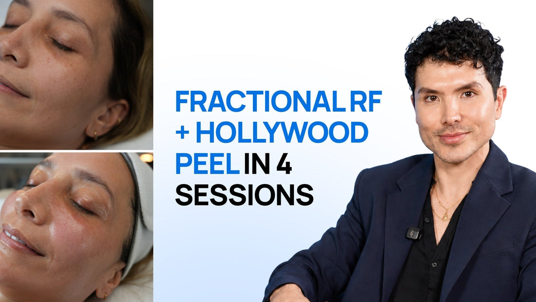 How to Build a Fractional RF + Hollywood Peel Course Protocol for Dull Skin With Uneven Tone