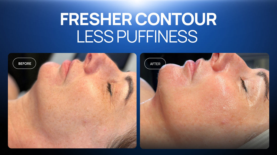 How a Cold-Therapy Protocol Refreshed the Look of a Client's Skin in One Session