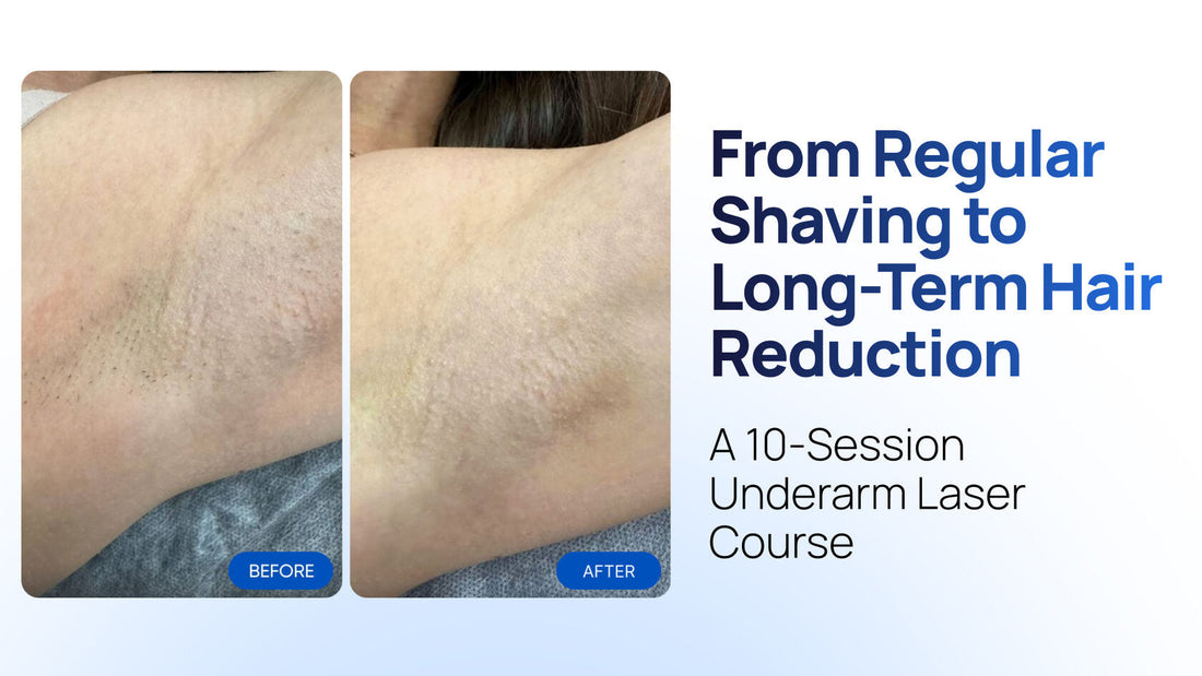 From Regular Shaving to Long-Term Hair Reduction: A 10-Session Underarm Case on the Zemits Quidion Lite Pro