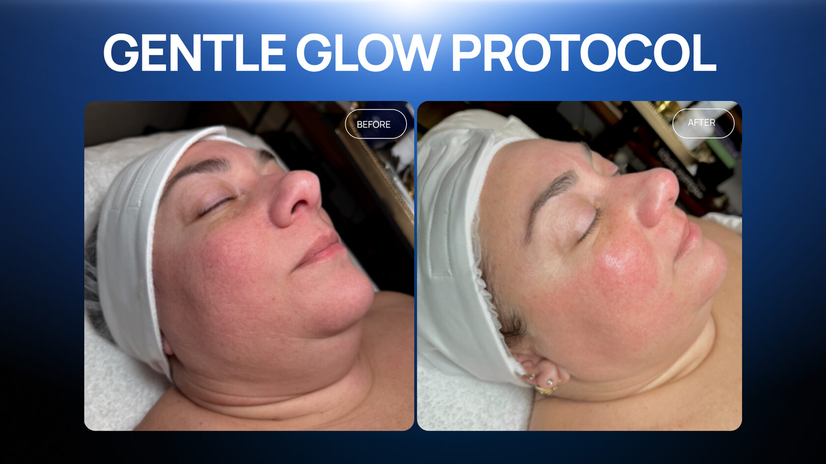 A Gentle Glow Protocol for Sensitive, Redness-Prone Skin — in One Session