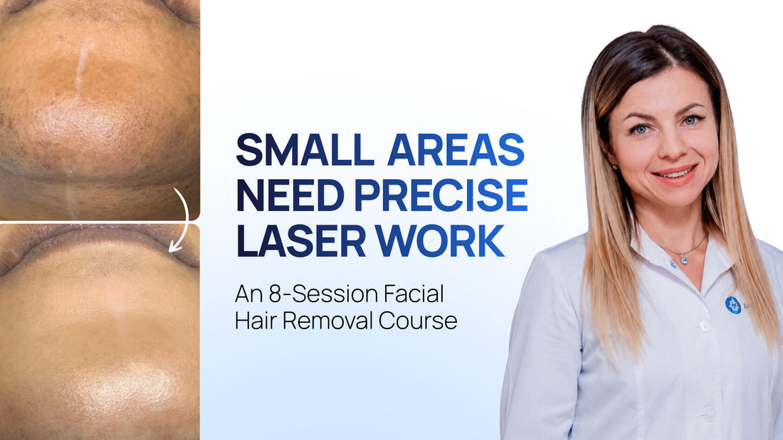 A Comfortable Laser Hair Removal Course for Dry, Pigmentation-Prone Skin: 10 Sessions for Fitzpatrick Skin Type III