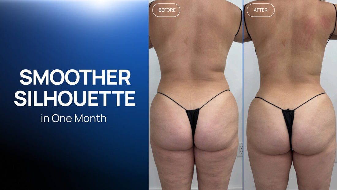 A Multi-Step Body-Contouring Protocol: A Smoother Silhouette in One Month