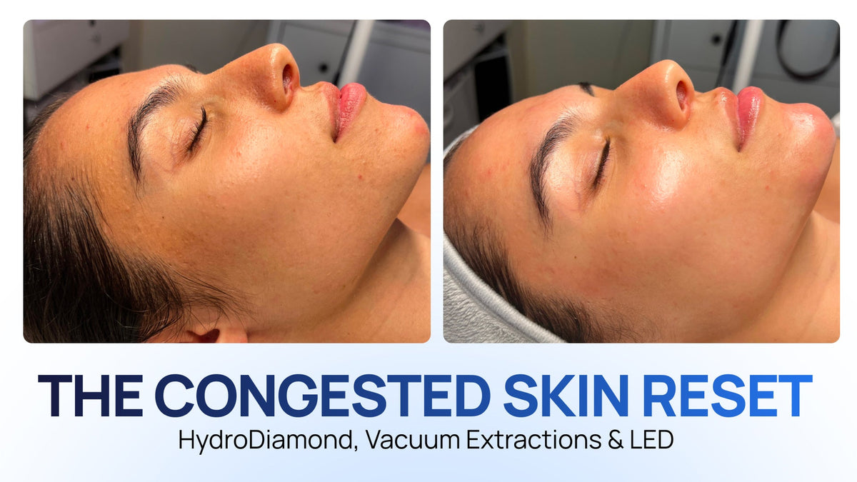 A Step-by-Step Decongesting Facial Protocol with HydroDiamond and LED