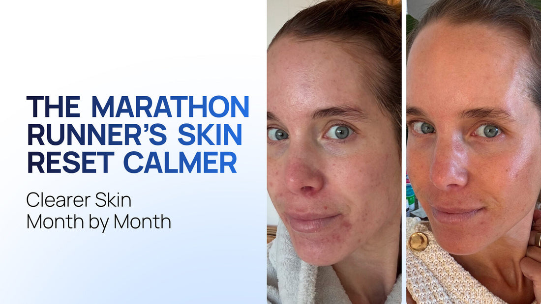 Calm & Clear: A Monthly Protocol for Breakout-Prone Skin with a Reactive Perioral Zone