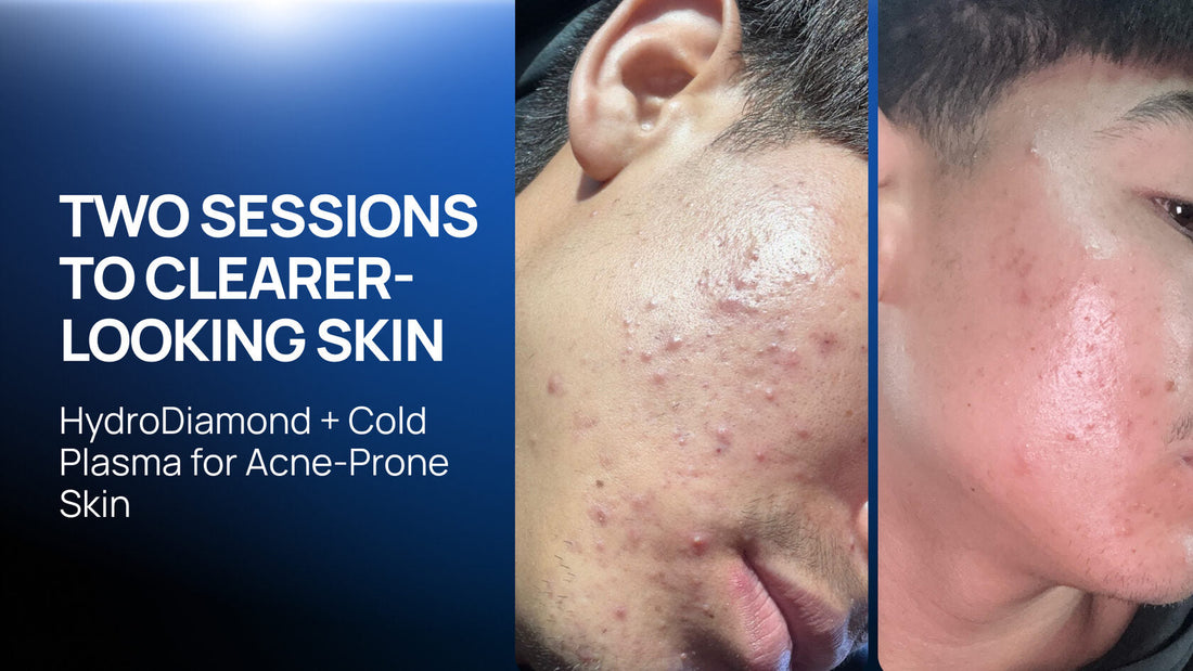 Two Sessions, One Sequence: Pairing HydroDiamond® and Cold Plasma for Acne-Prone Skin