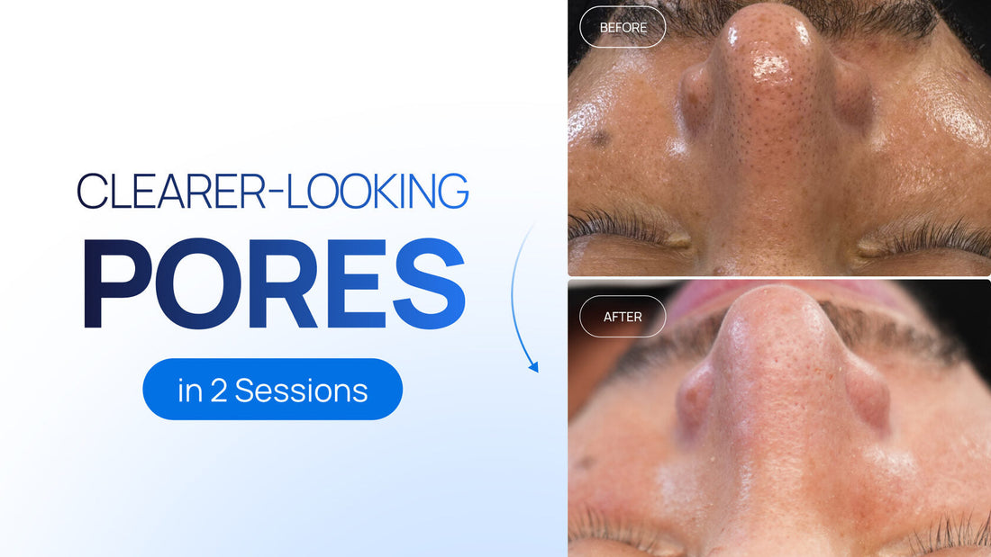 How to Build a Deep Clean Protocol for Oily, Breakout-Prone Skin