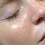 HydroDermabrasion serum treatment result 1