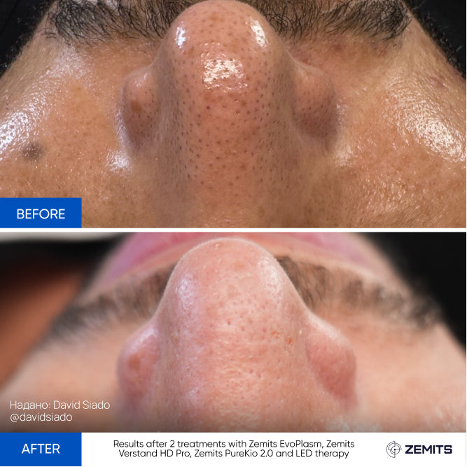 Before After Slide 1