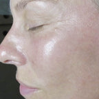 HydroDermabrasion serum treatment result 2