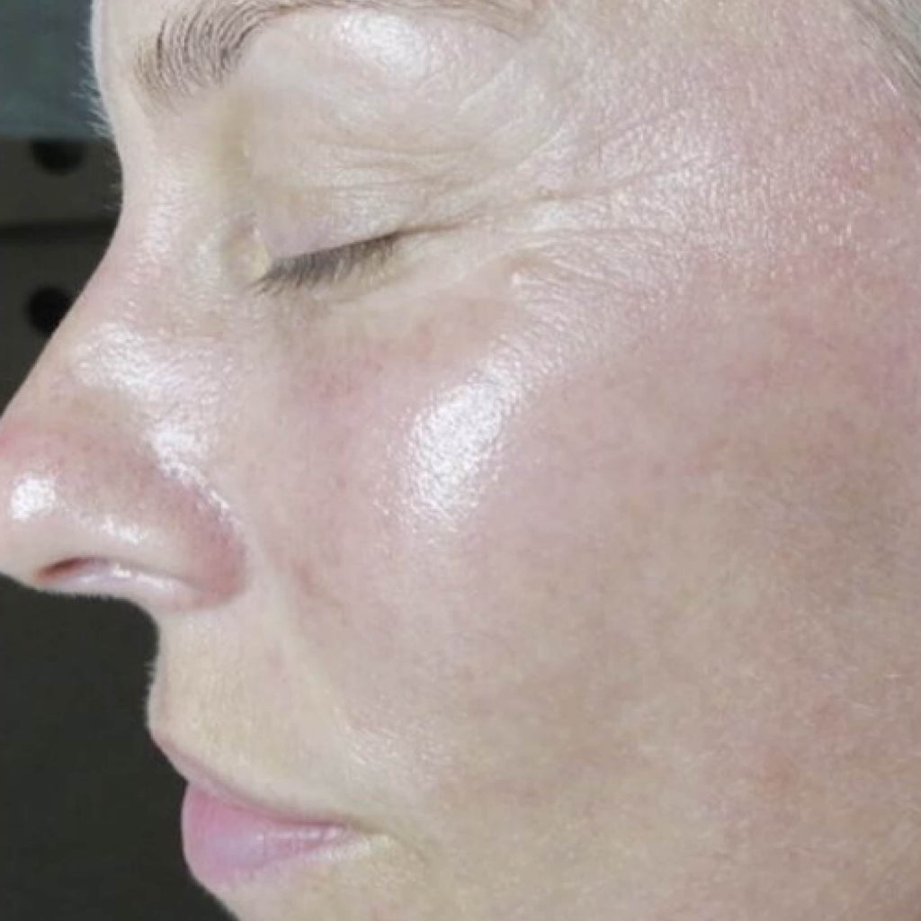 HydroDermabrasion serum treatment result 2