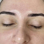 HydroDermabrasion serum treatment result 3