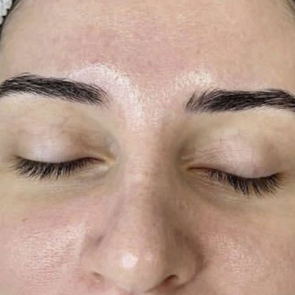 HydroDermabrasion serum treatment result 3