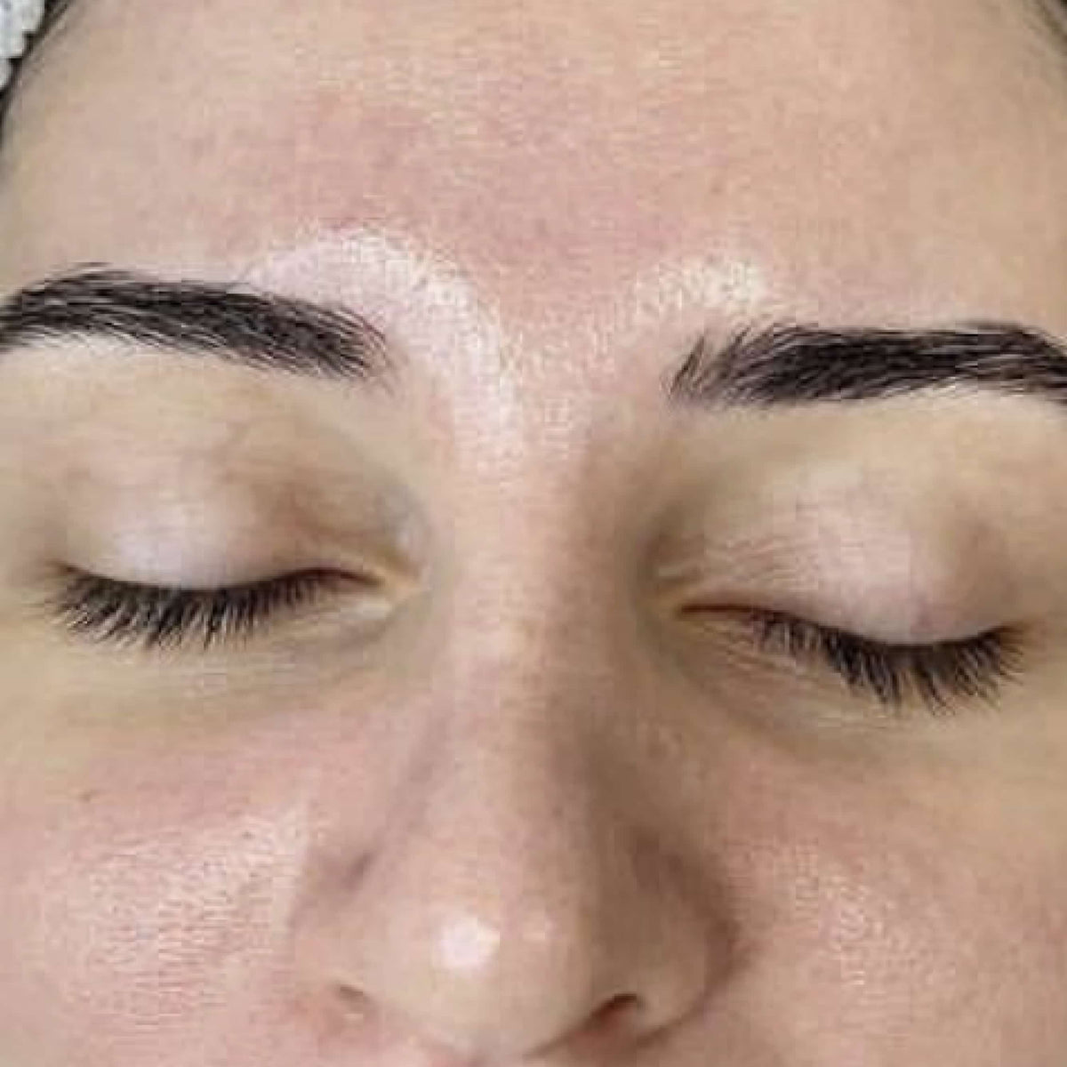 HydroDermabrasion serum treatment result 3