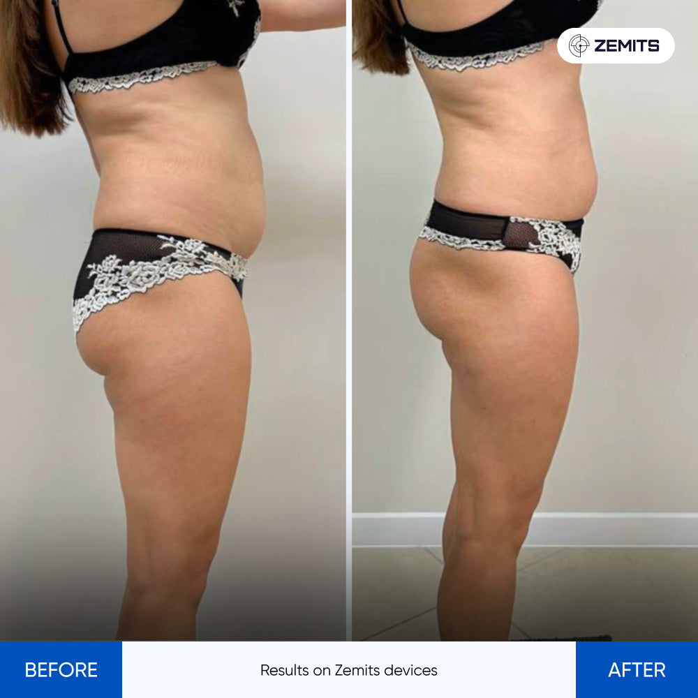 Before After Slide 1
