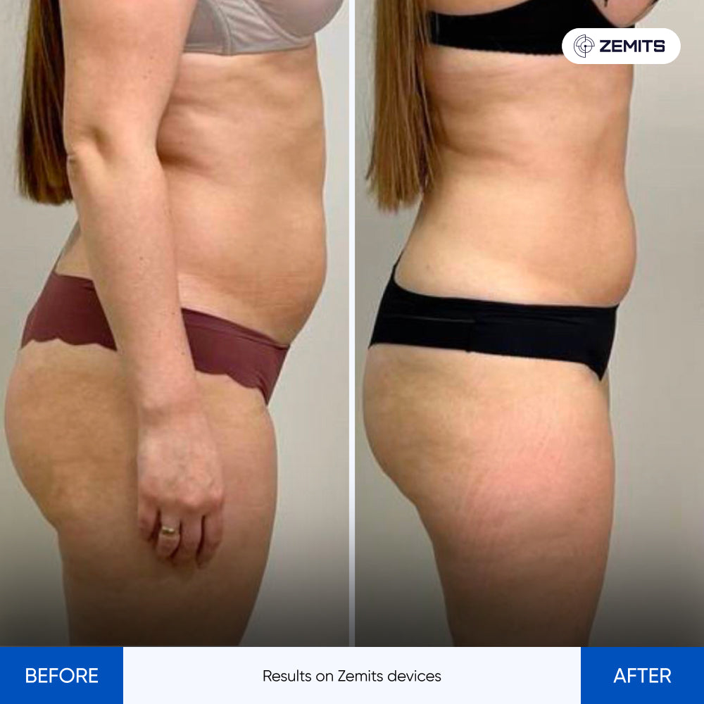 Before After Slide 2