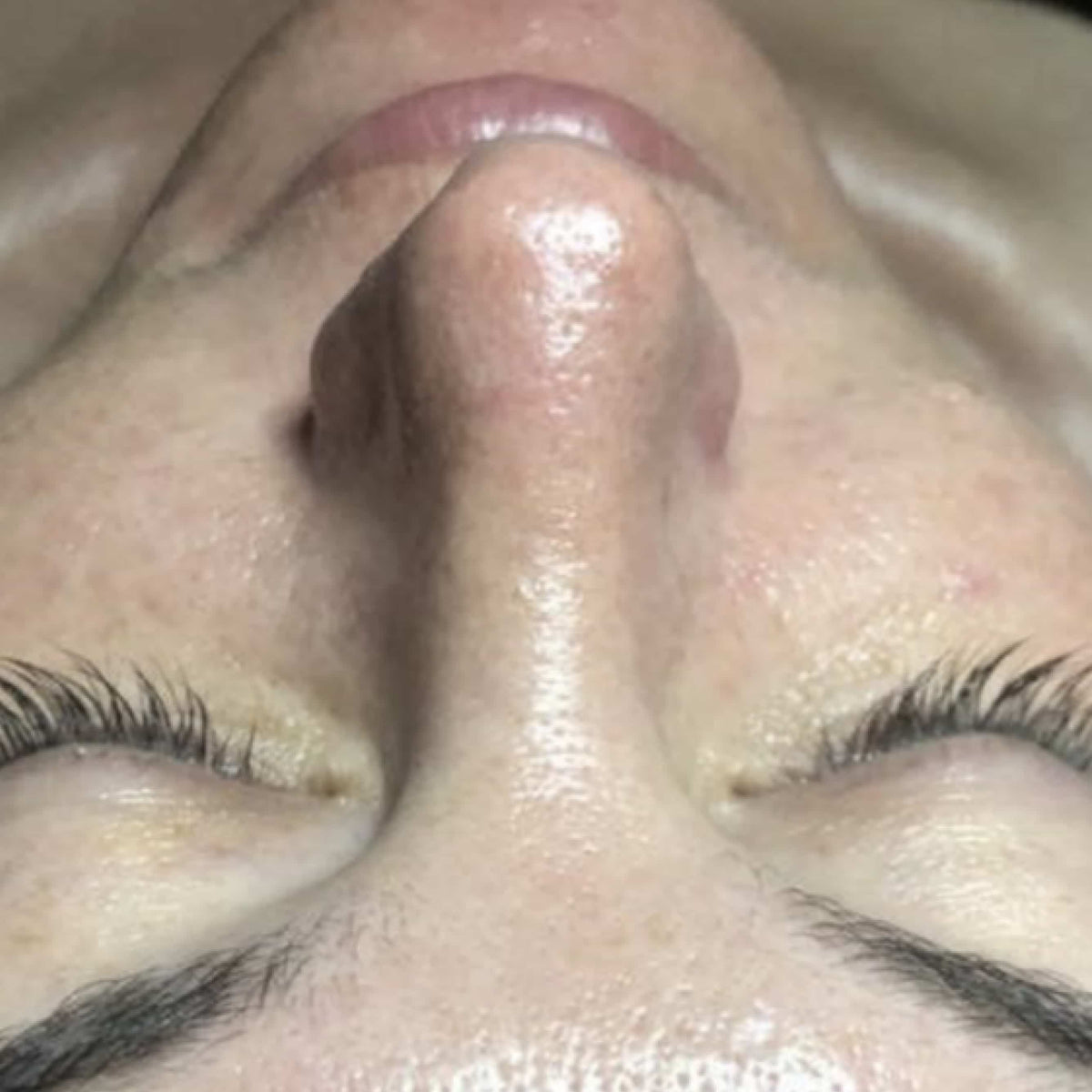 HydroDermabrasion serum treatment result 4