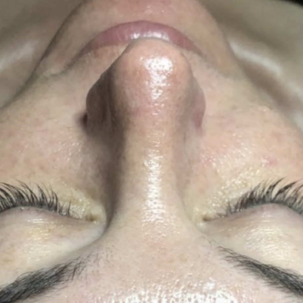 HydroDermabrasion serum treatment result 4