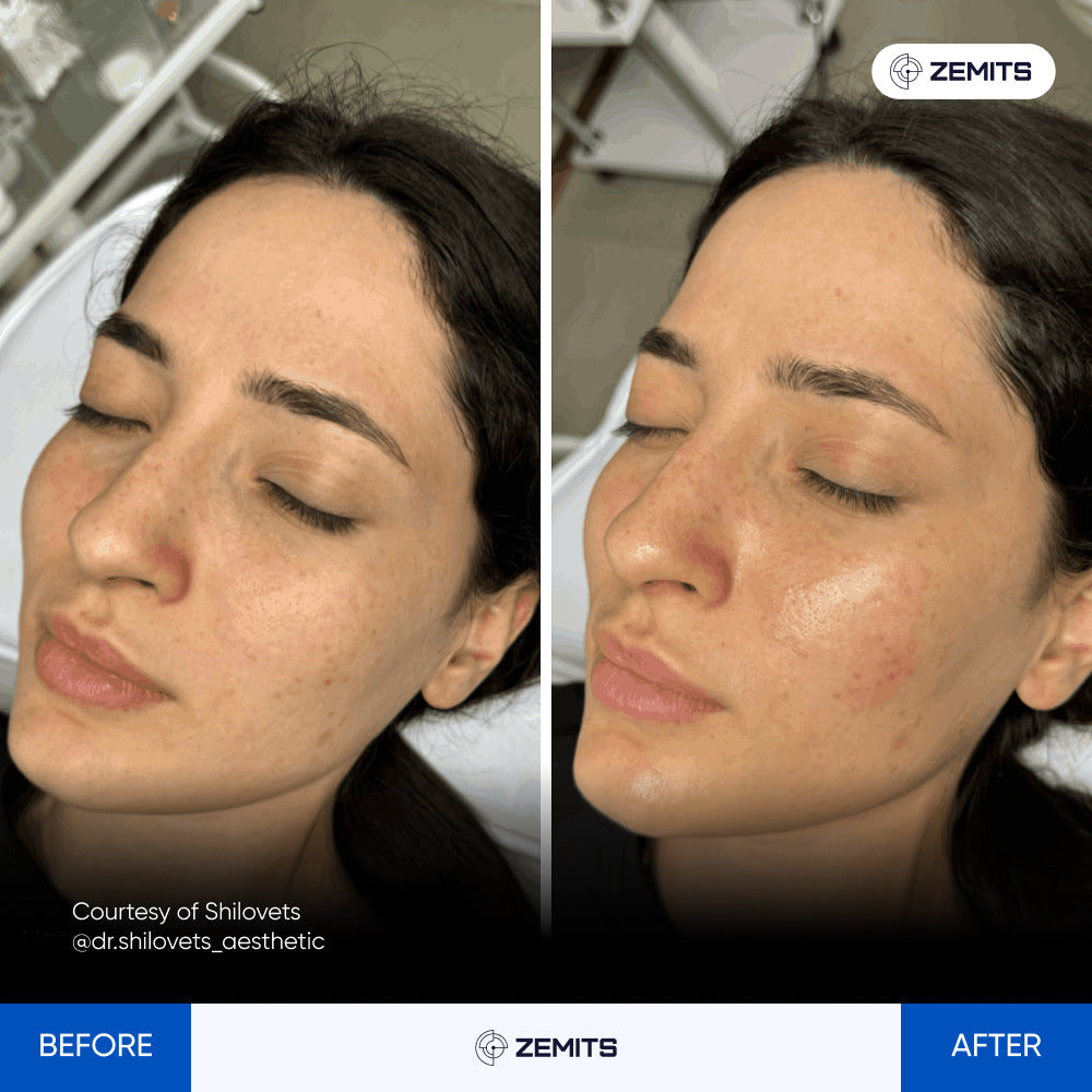 Before After Slide 1