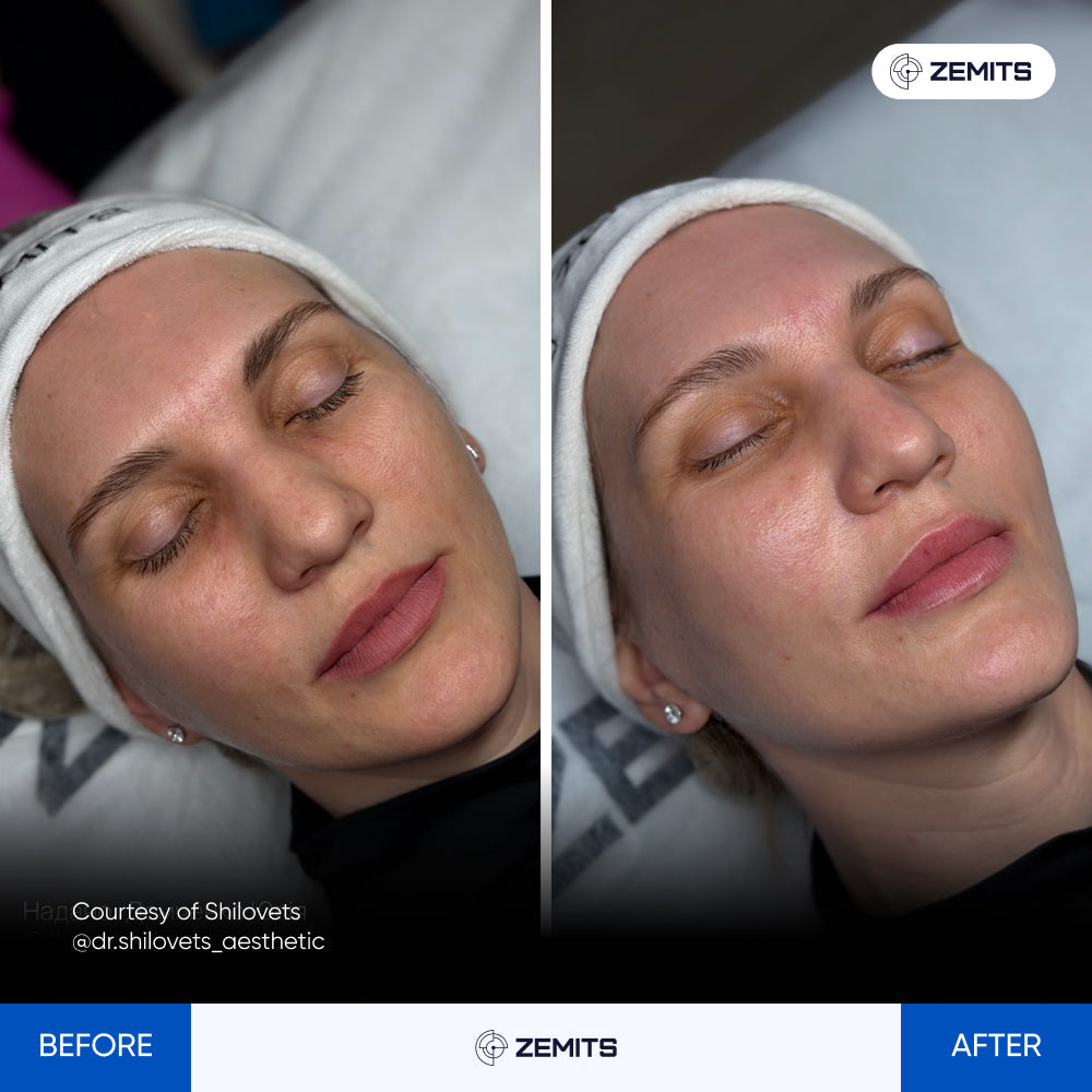 Before After Slide 2