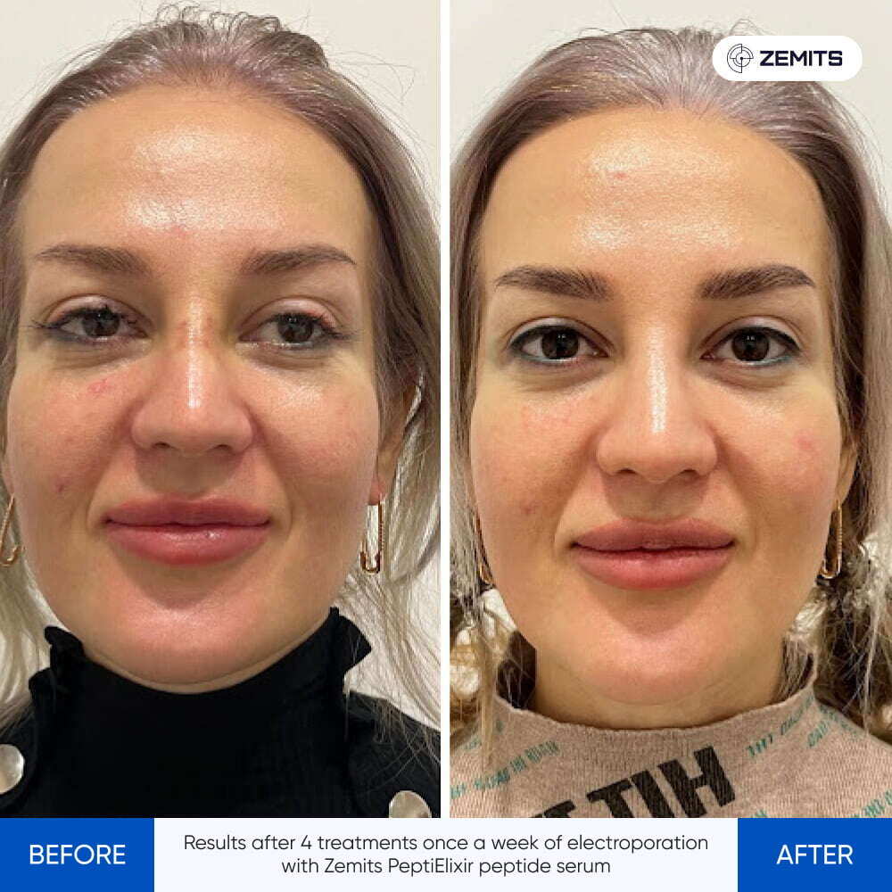 Before After Slide 3