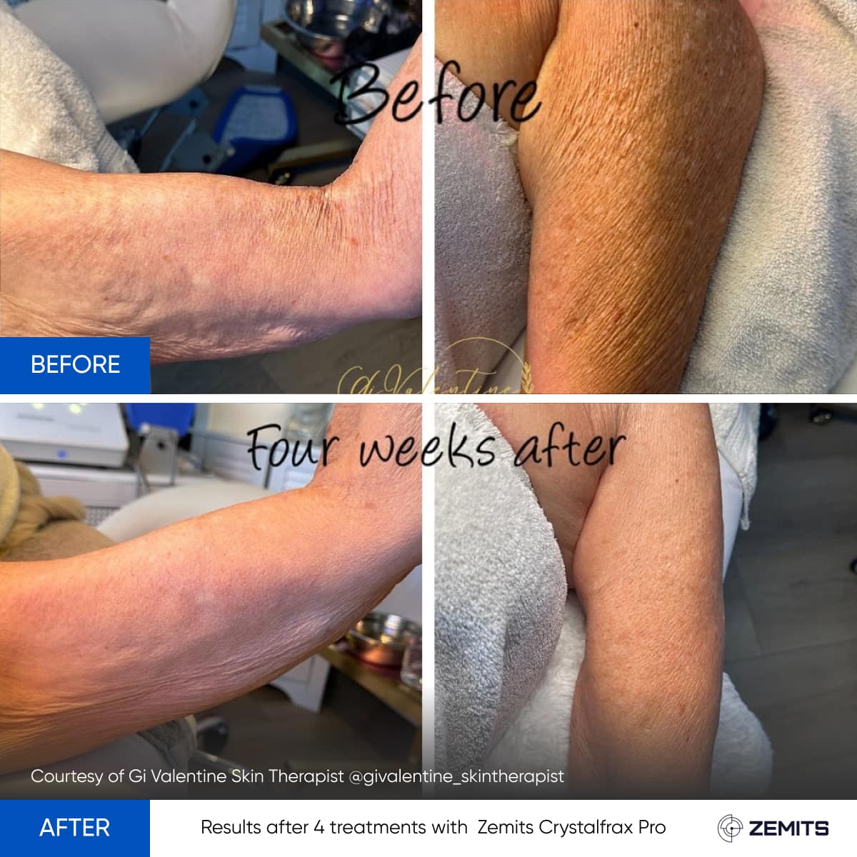 Before After Slide 4