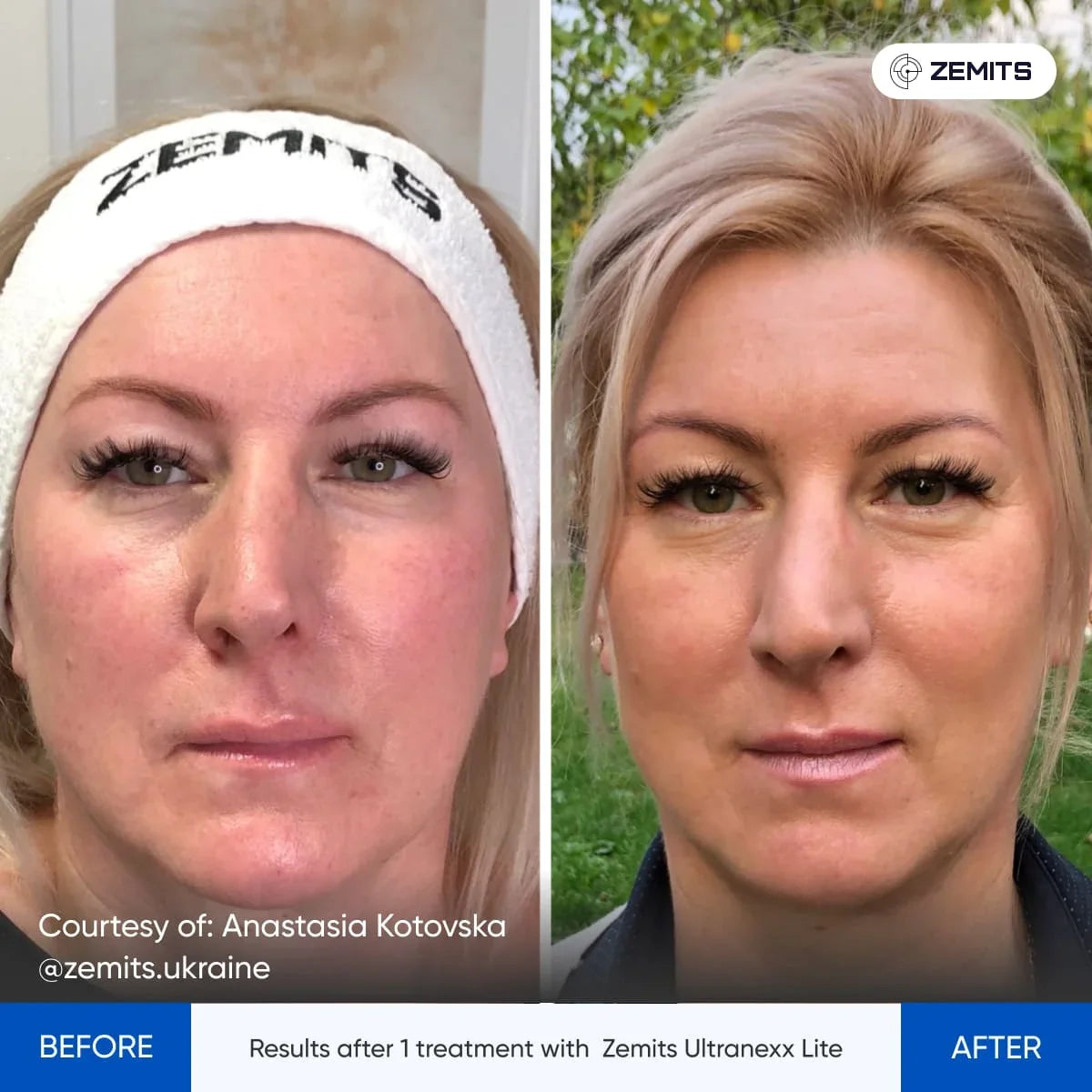 Before After Slide 1