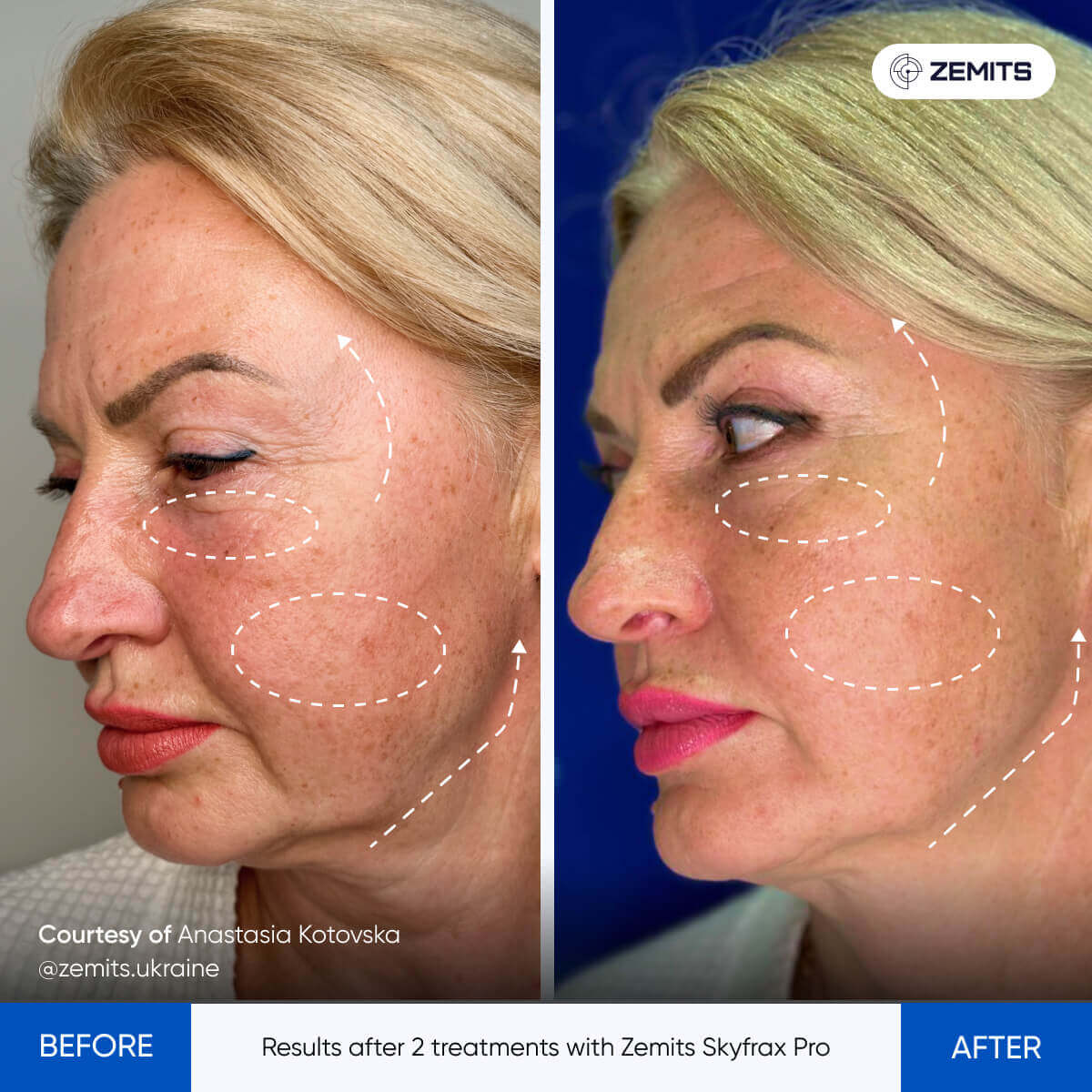 Before After Slide 4