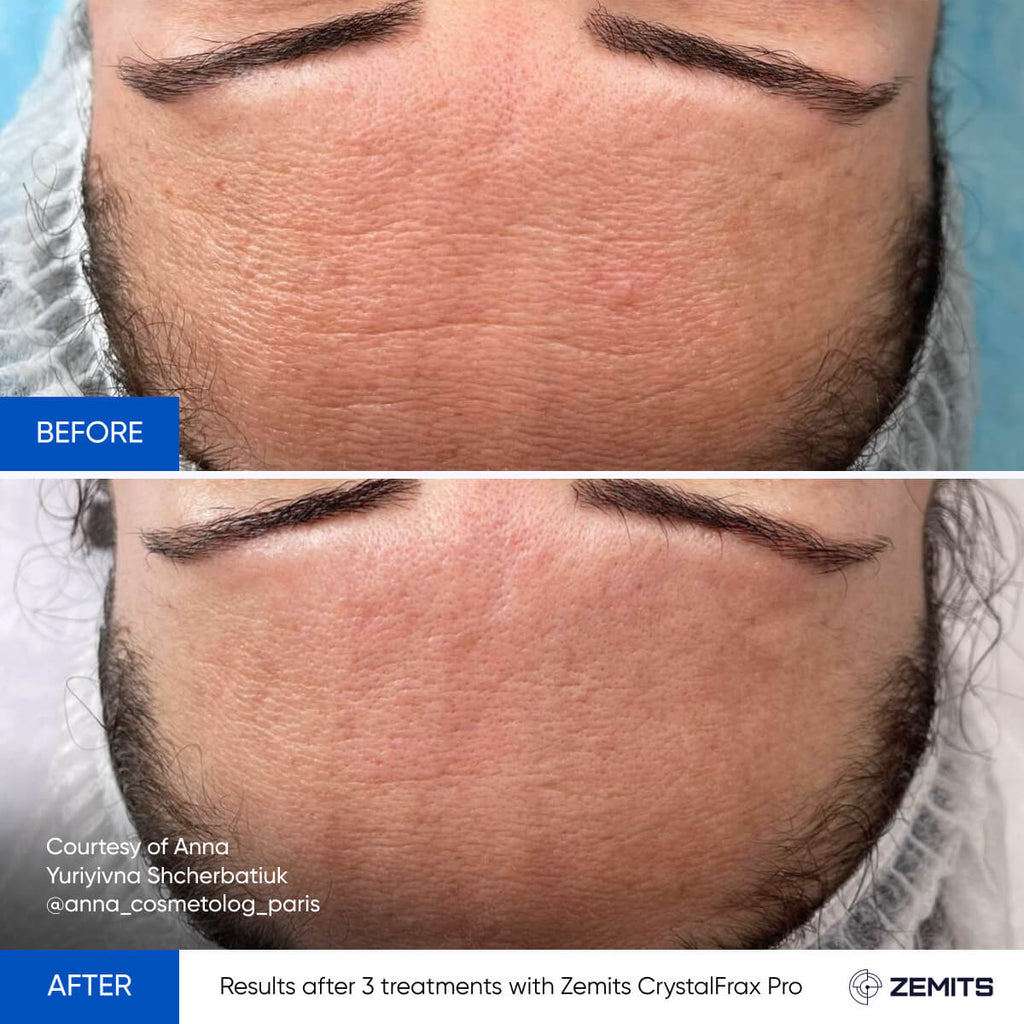 CrystalFrax Pro MD results after 3 treatments