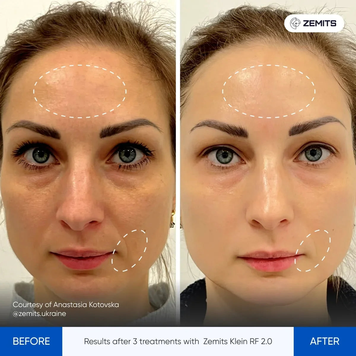 Before After Slide 13