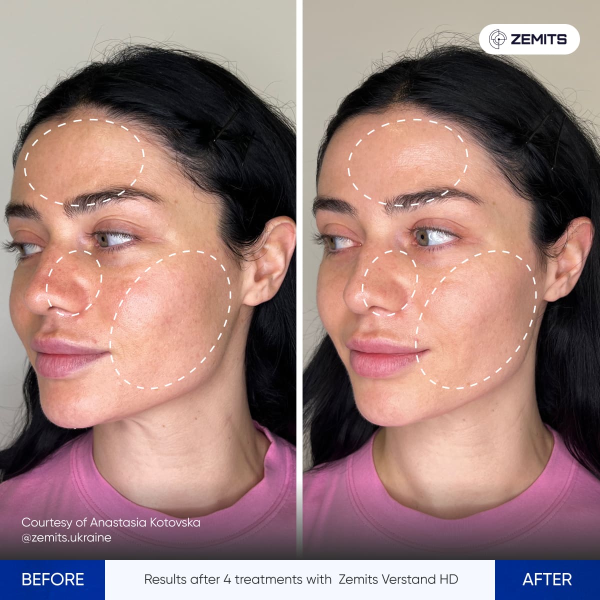 Before After Slide 1