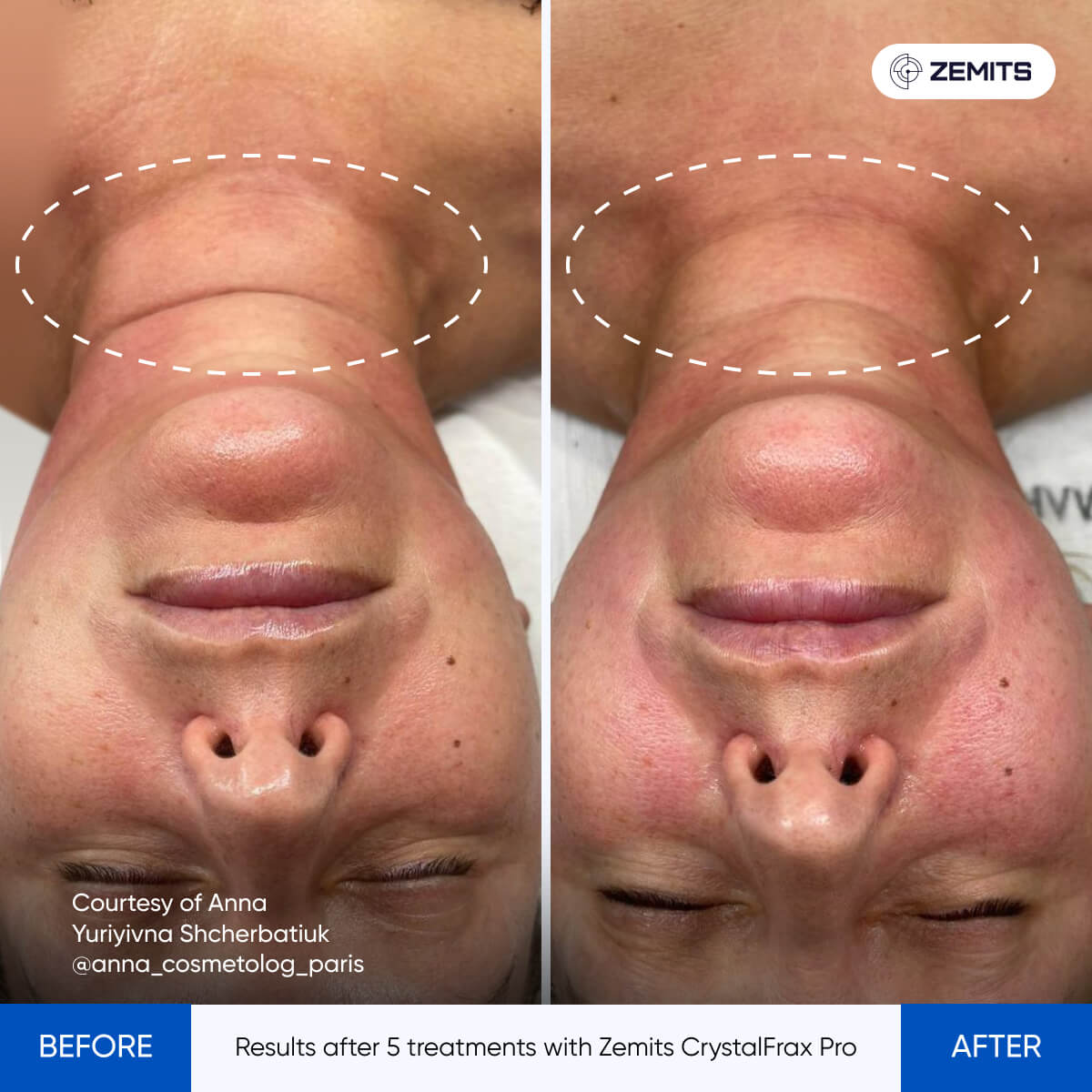 CrystalFrax Pro MD results after 5 treatments