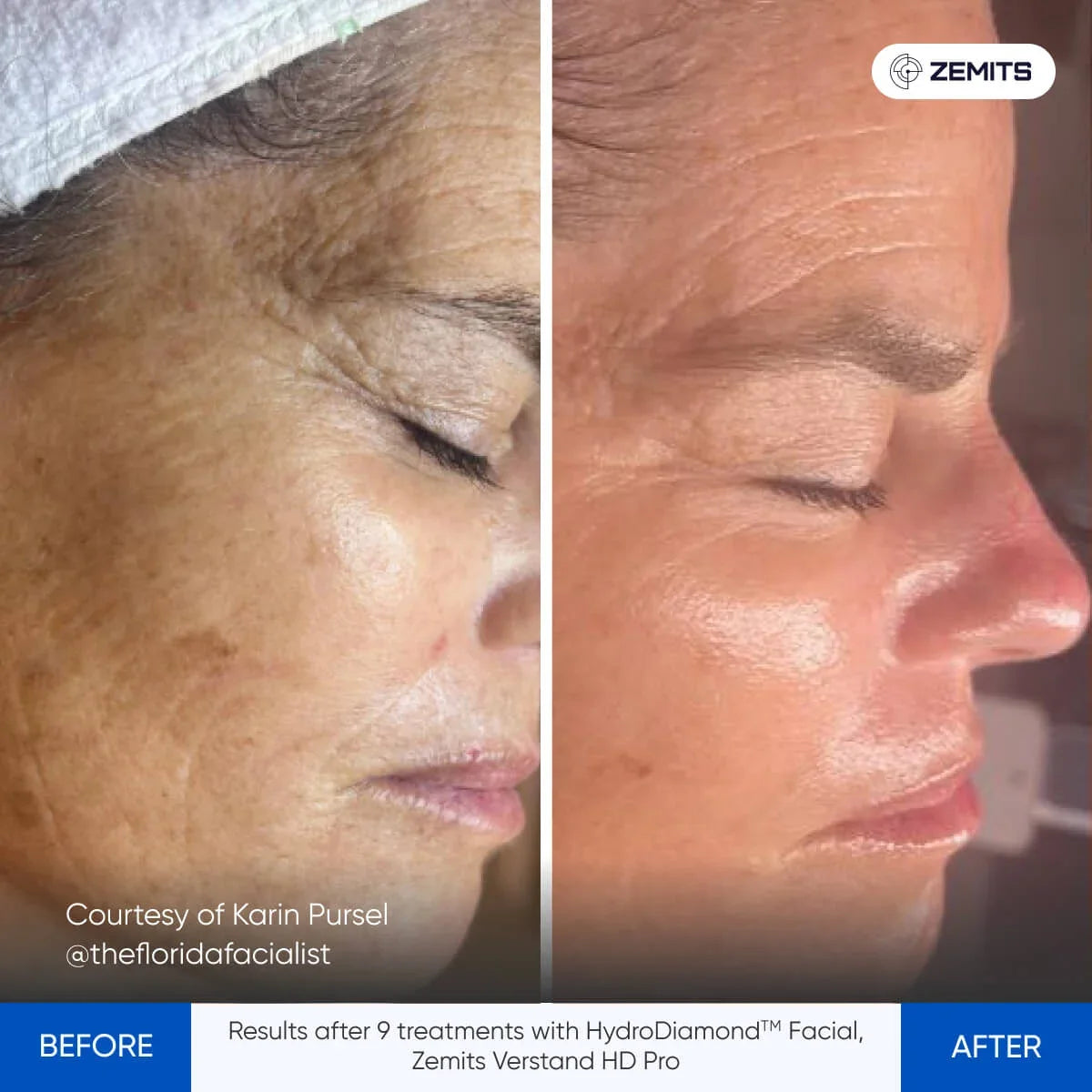 Before After Slide 4