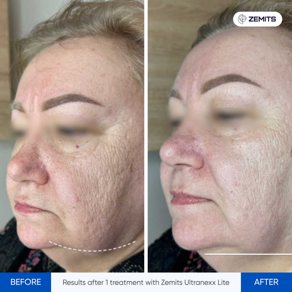Before After Slide 3