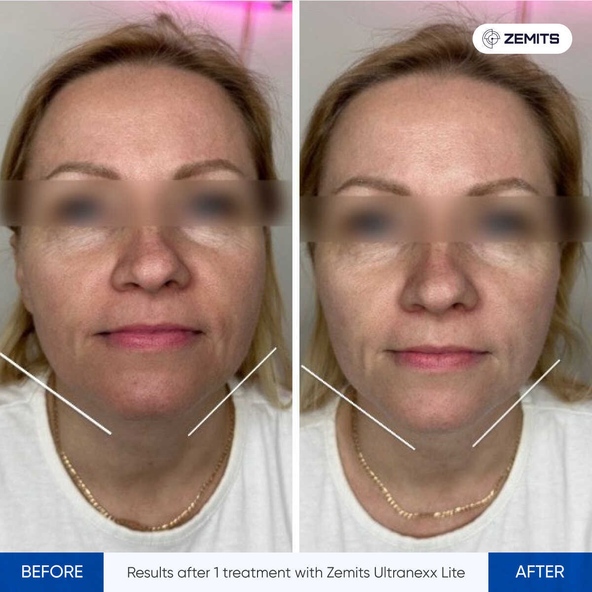 Zemits UltraNexx Lite