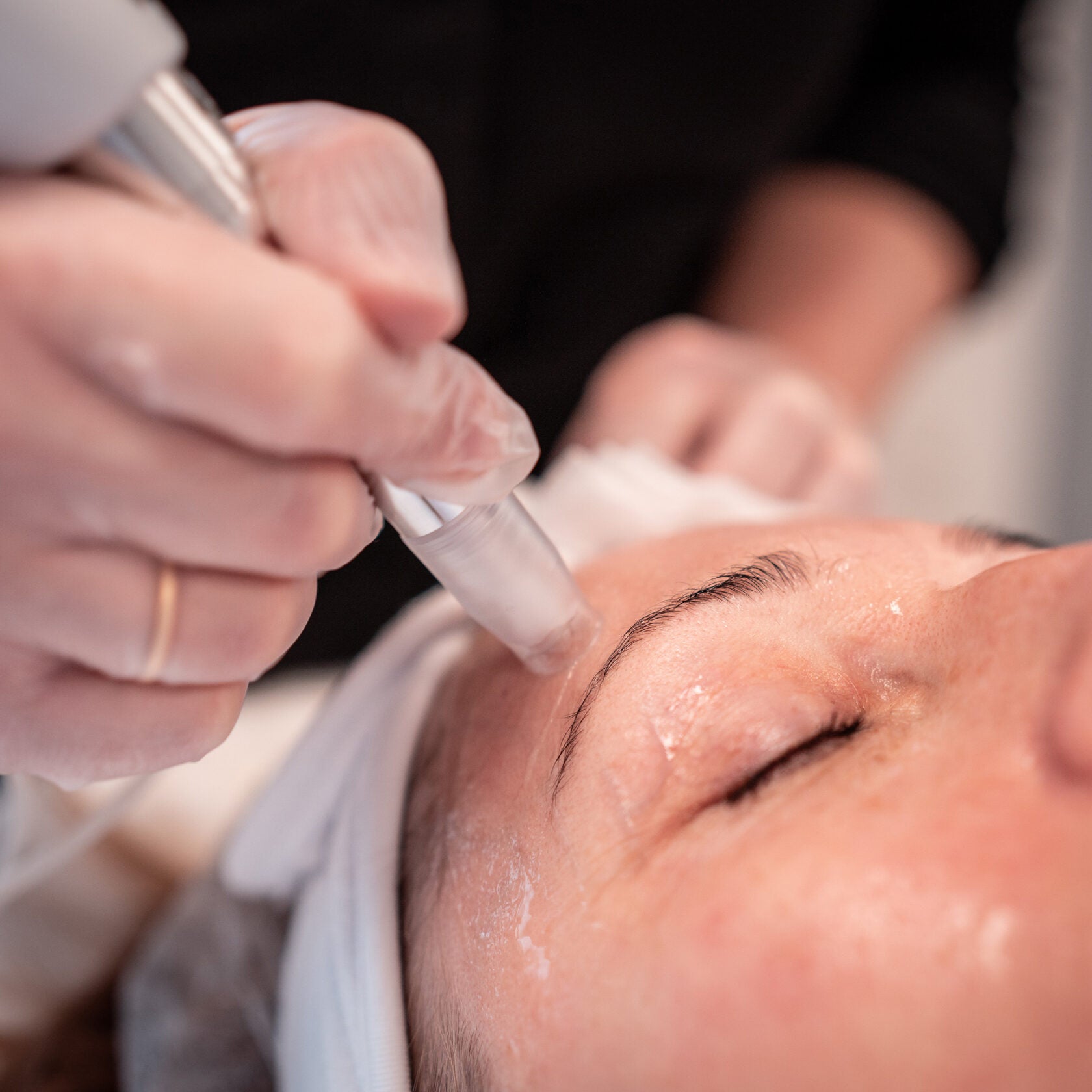 XCellarisPRO Twist forehead treatment close-up