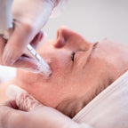 Microneedling treatment with XCellarisPRO Twist on cheek