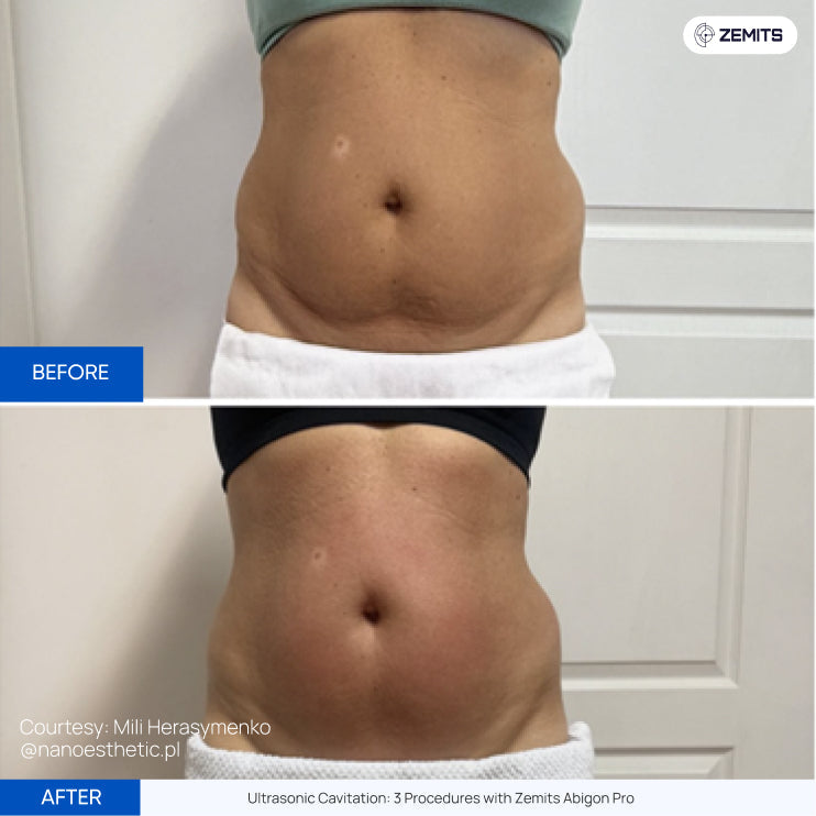 Before After Slide 1