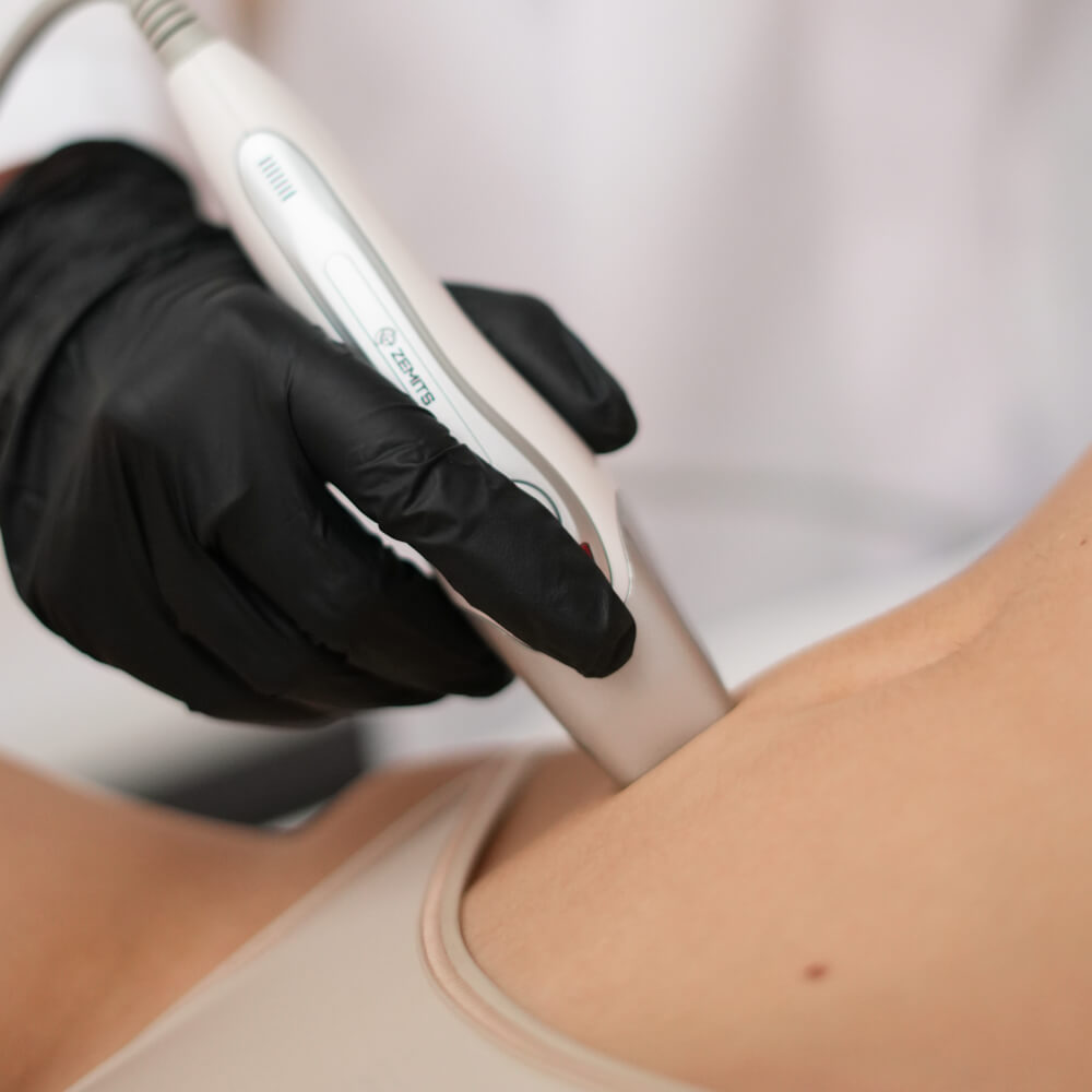 Zemits CrystalFrax Pro MD — treatment