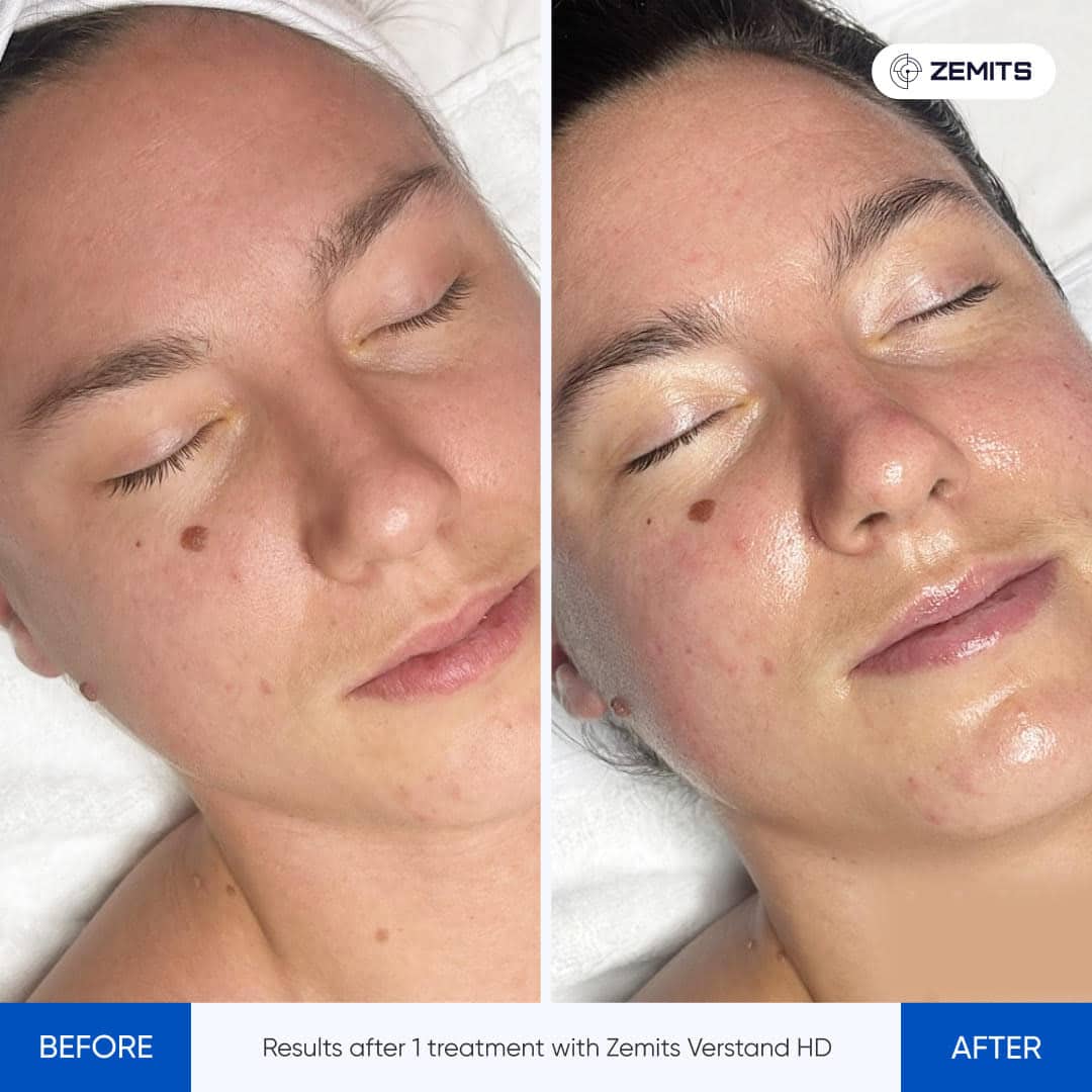 Before After Slide 2